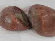 Em caso raríssimo, médicos descobrem pedras ‘gigan