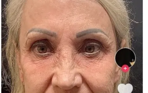 Mulher ‘troca de rosto’ após procedimento estético