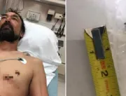 Homem dirige até hospital com prego cravado no cor