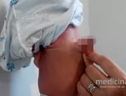 Bebê assusta médicos ao nascer com pênis do irmão 