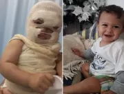 Bebê de 1 ano tem rosto desfigurado por água ferve