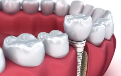 Tendências da implantodontia na era da Odontologia
