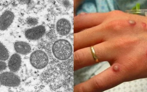 Itaperuna, RJ, confirma primeiro caso de varíola dos macacos